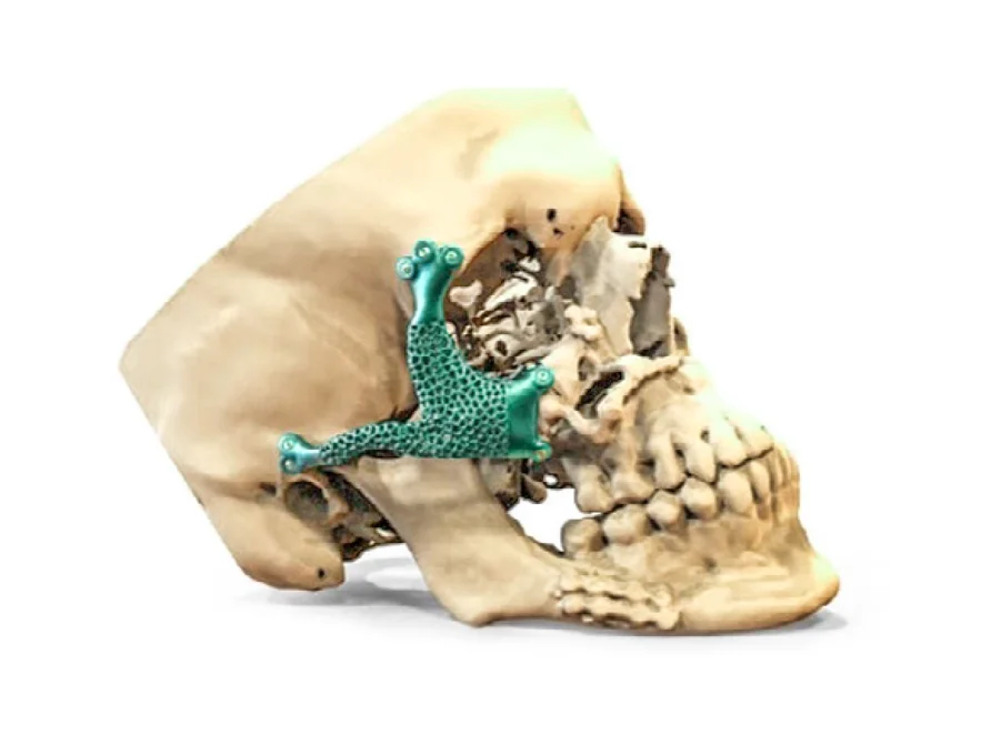 A turquoise-colored implant prototype of a zygomatic bone, digitally placed onto a skull